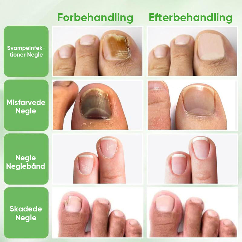 Ingefær essens til neglebehandling