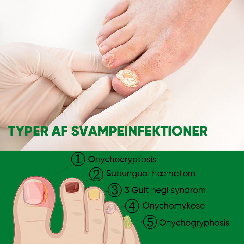 Ingefær essens til neglebehandling